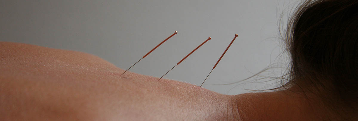 Akupunktur i nakke